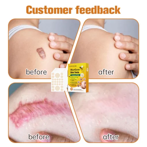 LOVILDS™ WartGone Bee Venom Treatment Patch - Image 9