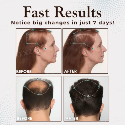 Hairgenz™ 𝕊𝕒𝕧𝕖 𝕦𝕡 𝕥𝕠 𝟠𝟘% 🅳🅸🆂🅲🅾🆄🅽🆃🆂 Hair Regrowth Capsules